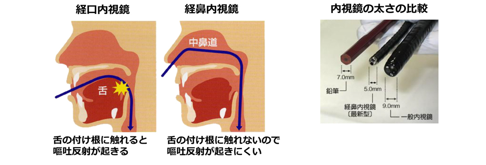 内視鏡検査